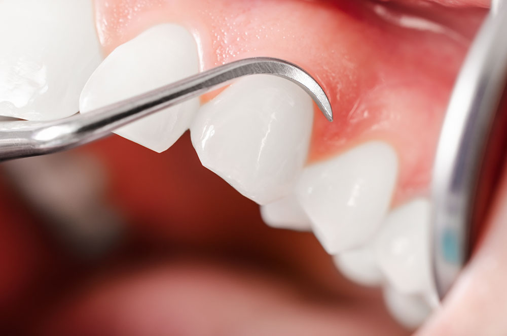 Assainissement parodontal - Cabinet dentaire Paris 17 - Drs Delesti et Coppola