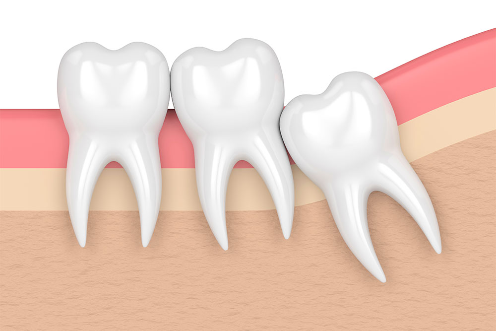 Dents de sagesse - Cabinet dentaire Paris 17 - Drs Delesti et Coppola