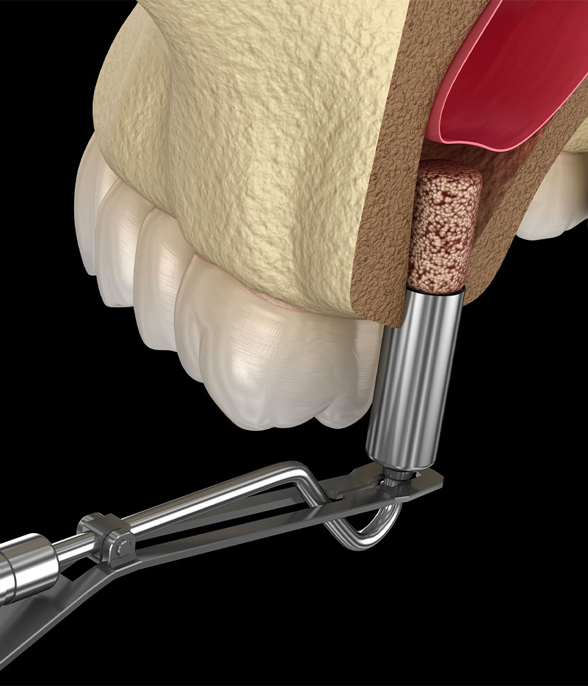 Sinus Lift Paris 17 - Cabinet dentaire Paris 17 - Drs Delesti et Coppola